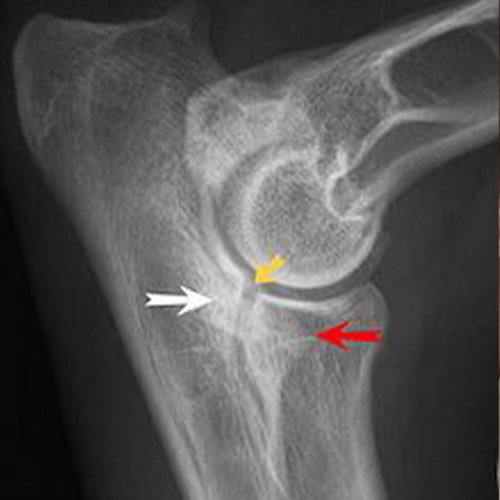 Rechtes Ellbogengelenk eines Hundes mit FCP und Osteoarthrose.
* gelber Pfeil: Stufe zwischen den gelenkbildenden Anteilen von Elle und Speiche
* roter Pfeil: fehlende vordere Kontur des Processus coronoideus (hinweisend auf einen FCP)
* weißer Pfeil: Sklerosierung der Ulna (typisch für eine Osteoarthrose).
Bildquelle: Wikipedia