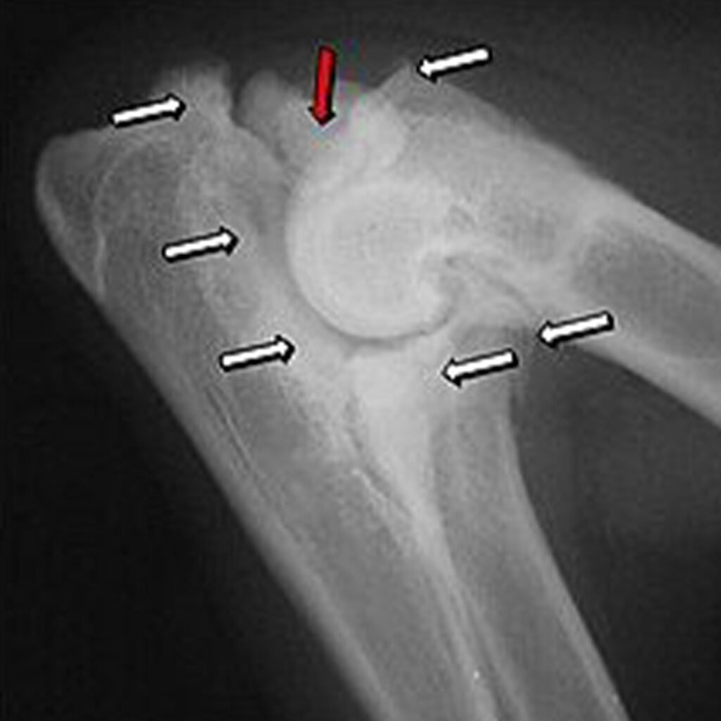 Rechtes Ellbogengelenk mit IPA und Osteoarthrose. IPA (roter Pfeil) sowie Sklerosierungen und Osteophyten (weiße Pfeile) bei einem fünf Jahre alten Deutschen Schäferhund.
Bildquelle: Wikipedia