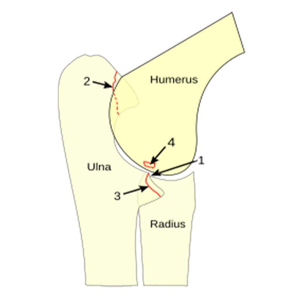 Typische ED-Manifestationen
1 Stufenbildung zwischen Elle (Ulna) und Speiche (Radius)
2 Isolierter Processus anconaeus
3 Fragmentierter Processus coronoideus medialis
4 OCD des medialen Condylus
Bildquelle: Wikipedia