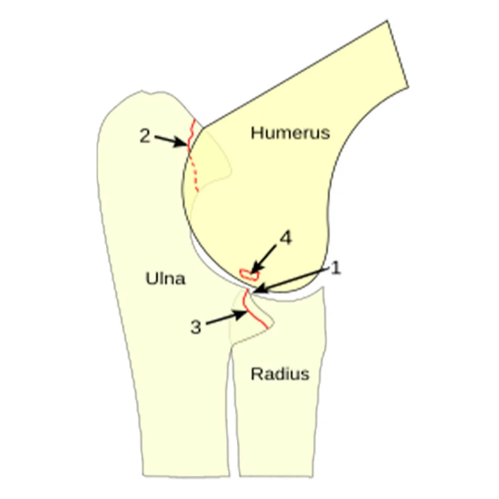 Typische ED-Manifestationen
1 Stufenbildung zwischen Elle (Ulna) und Speiche (Radius)
2 Isolierter Processus anconaeus
3 Fragmentierter Processus coronoideus medialis
4 OCD des medialen Condylus

Bildquelle: Wikipedia